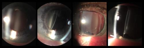 Artificial intraocular lens - calcification